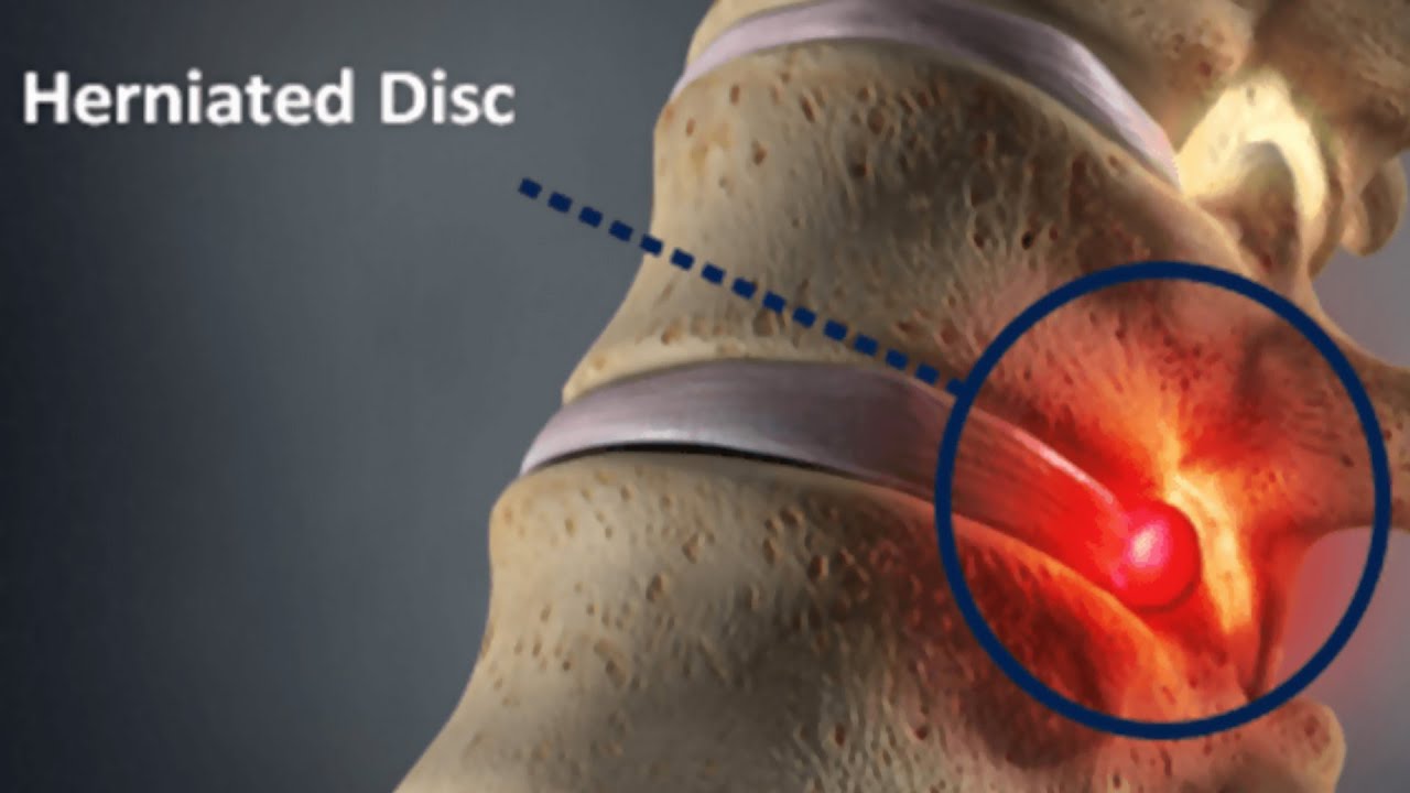 Herniated Disk Treatment